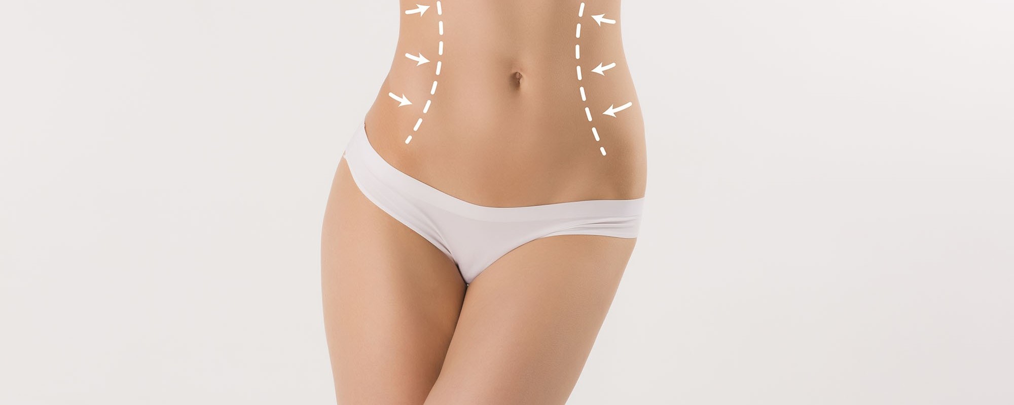 Lipoabdominoplastia