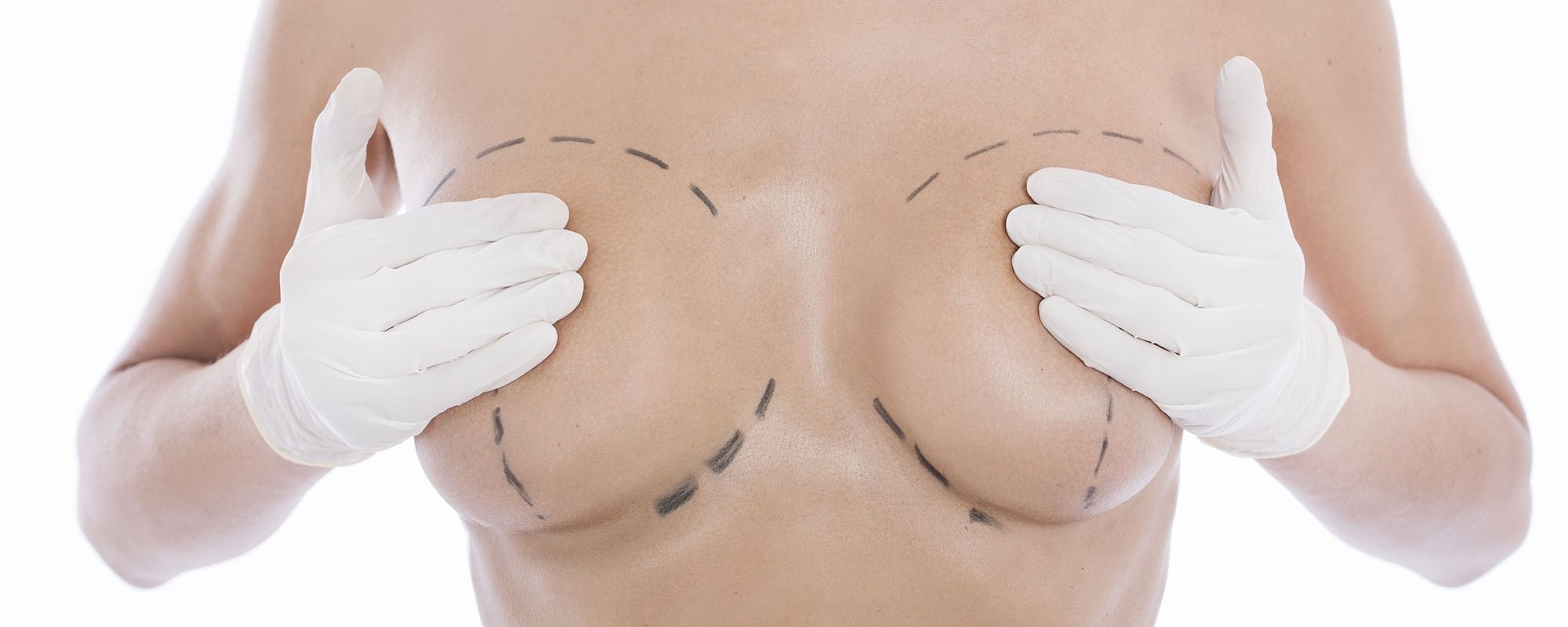 Mamoplastia